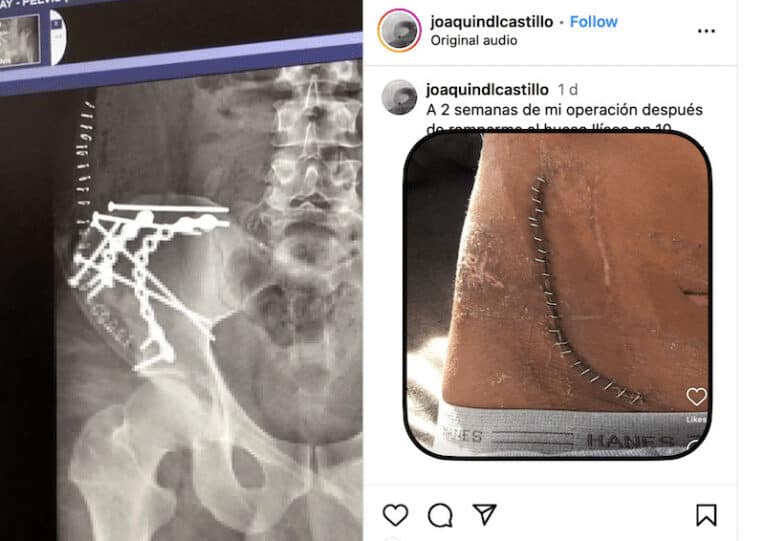 Joaquin Del Castillo breaks hip in Pipeline wipeout