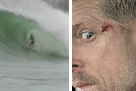 Mick Fanning's gruesome injury (right) and how he would have been forced to see the world had it been any closer to his eyeball. Photo: Instagram